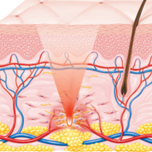 1 Inflammatory Phase